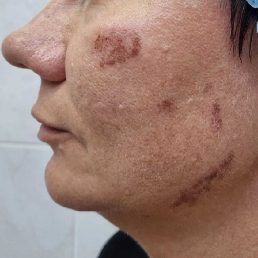 NeoGen омоложение лево до.jpg NeoGen омоложение лево до.jpg