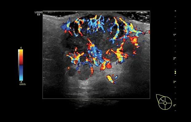 Клинические изображения УЗИ аппарат GE Healthcare Logiq E9 XDclear