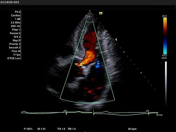 Клинические изображения Siemens Acuson NX2 аппарат УЗИ