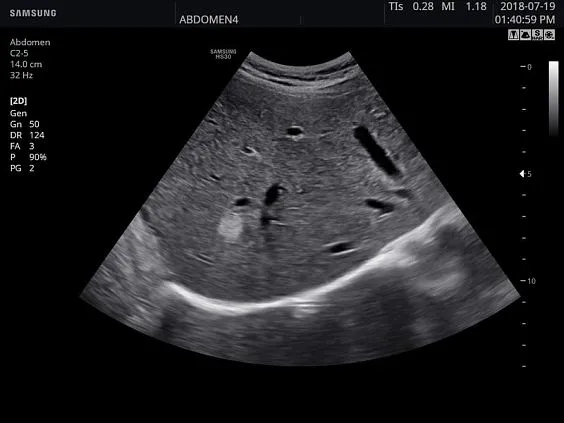 Клинические изображения Samsung Medison HS30 УЗИ аппарат