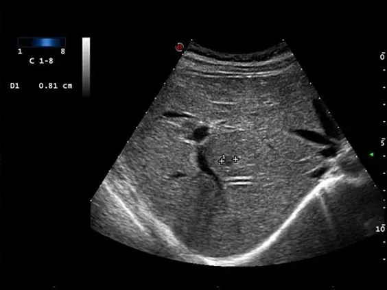 Клинические изображения УЗИ аппарат Esaote MyLab Eight