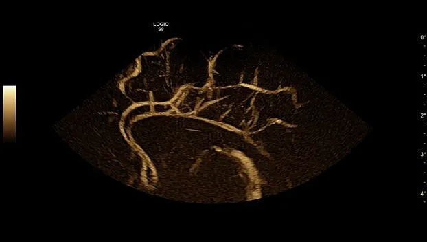 Клинические изображения GE Logiq S8 XDclear ультразвуковая диагностическая система 