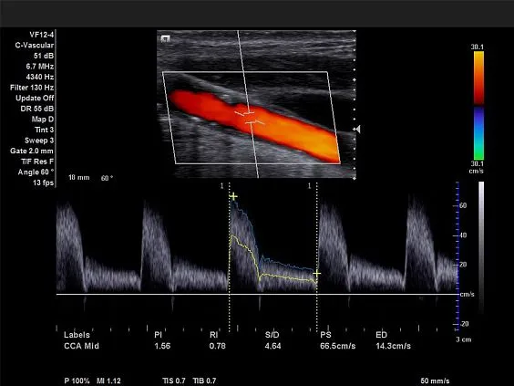 Клинические изображения Siemens Acuson X700 ультразвуковая система
