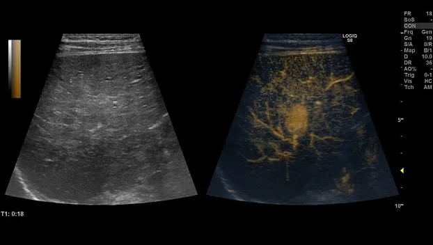 Клинические изображения GE Logiq S8 XDclear ультразвуковая диагностическая система 