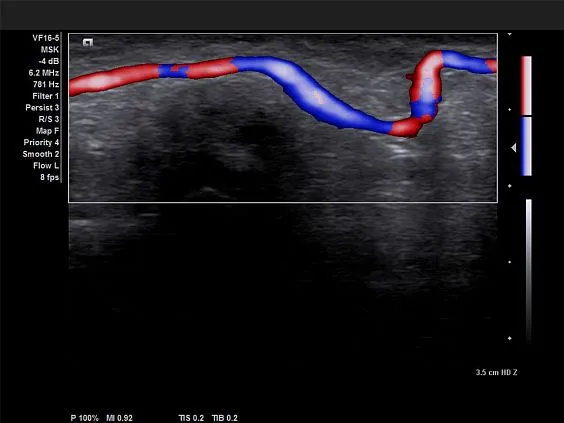 Клинические изображения Siemens Acuson X700 ультразвуковая система