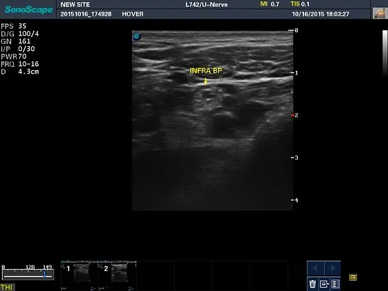 Клинические изображения Sonoscape S8 Exp ультразвуковой аппарат