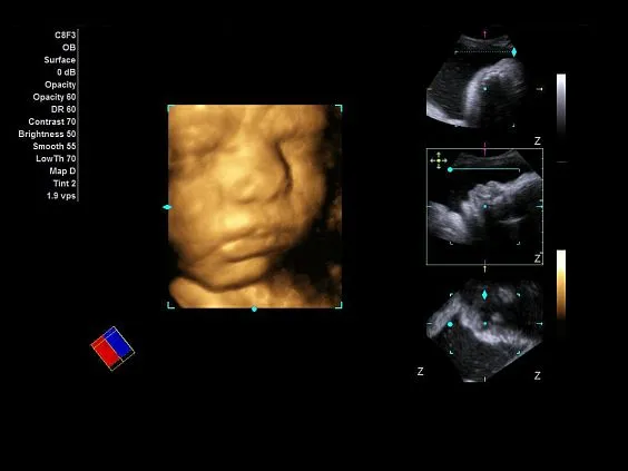 Клинические изображения Ультразвуковая система Siemens Acuson NX3