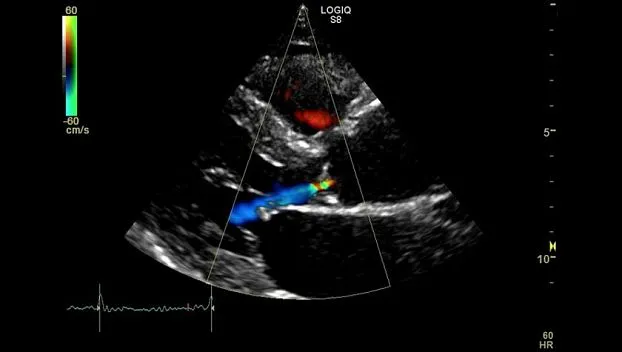 Клинические изображения GE Logiq S8 XDclear ультразвуковая диагностическая система 