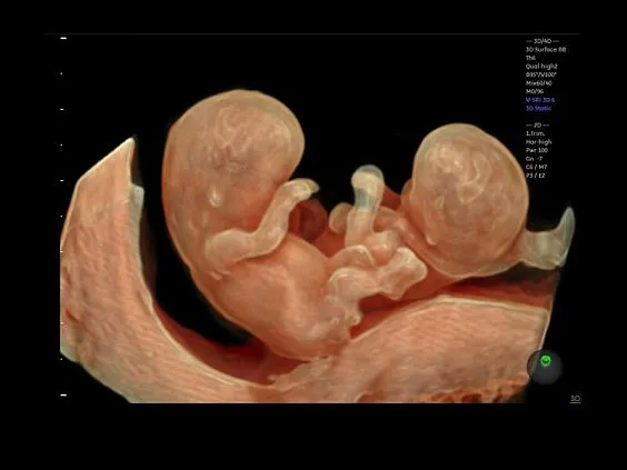 Клинические изображения Ультразвуковая диагностическая система GE Voluson E10