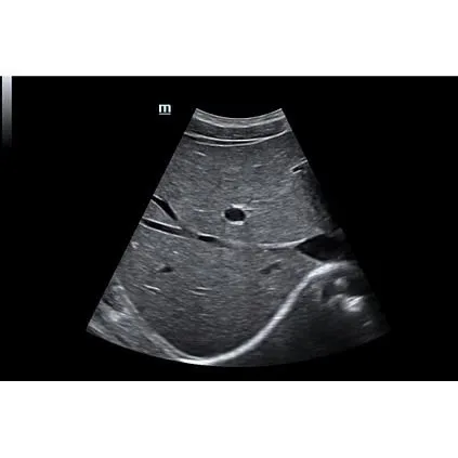 Клинические изображения УЗИ аппарат Mindray DC-70S