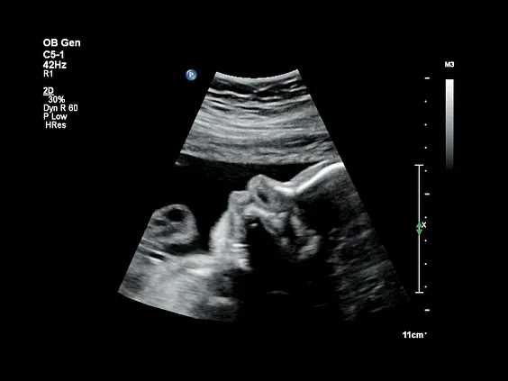 Клинические изображения Philips Affiniti 70 ультразвуковой аппарат