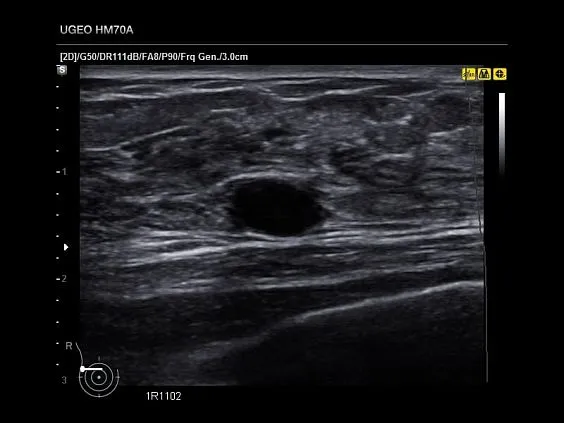 Клинические изображения Samsung Medison HM70 EVO УЗИ аппарат портативный