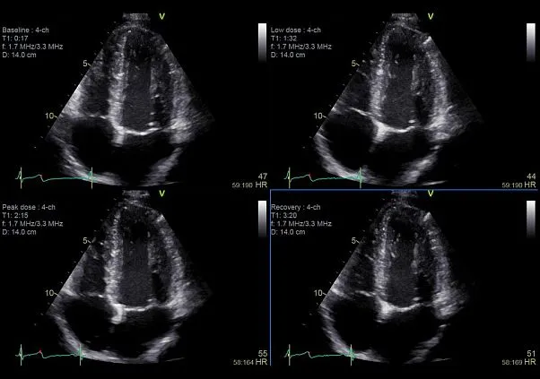 Клинические изображения GE Vivid S70 УЗИ аппарат