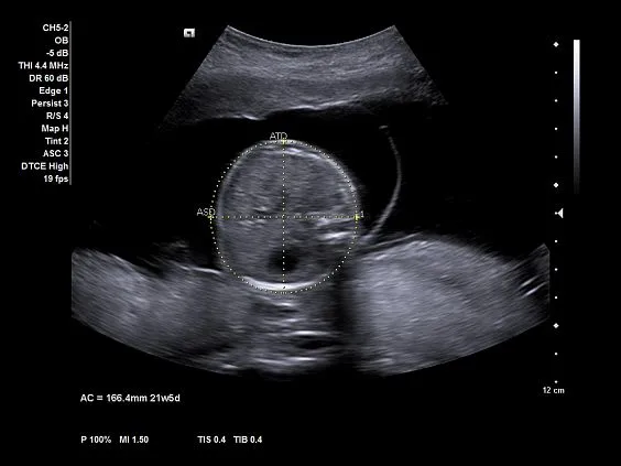 Клинические изображения Ультразвуковая система Siemens Acuson NX3