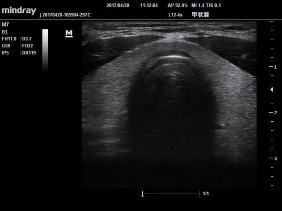 Клинические изображения УЗИ аппарат Mindray M7 портативный