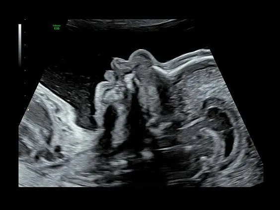 Клинические изображения Ультразвуковая диагностическая система GE Voluson E10