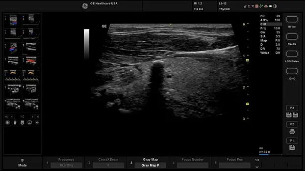 Клинические изображения GE HealthCare Versana Balance УЗИ аппарат