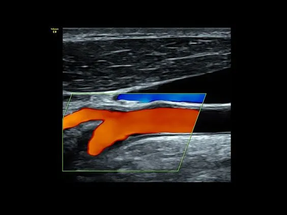 Клинические изображения УЗИ аппарат GE HealthCare Voluson E8 
