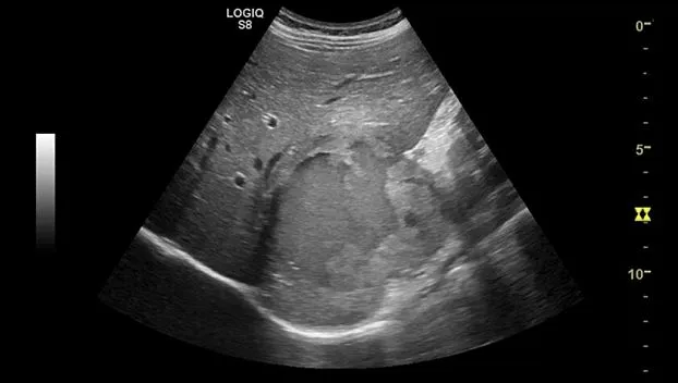 Клинические изображения GE Logiq S8 XDclear ультразвуковая диагностическая система 