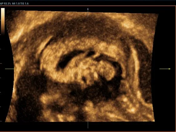 Клинические изображения УЗИ аппарат Mindray Resona 6