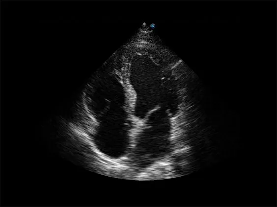 Клинические изображения Sonoscape X3 ультразвуковой аппарат