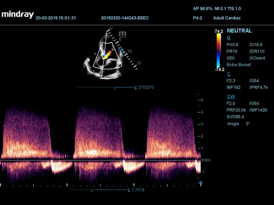 Клинические изображения УЗИ аппарат Mindray DC-60 X-Insight