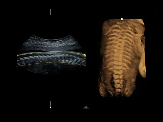 Клинические изображения Ультразвуковая диагностическая система GE Voluson E10