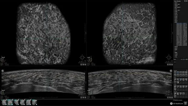 Клинические изображения GE HealthCare Invenia ABUS ультразвуковая система