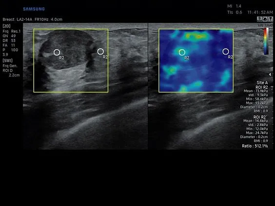 Клинические изображения Samsung Medison RS85 УЗИ аппарат