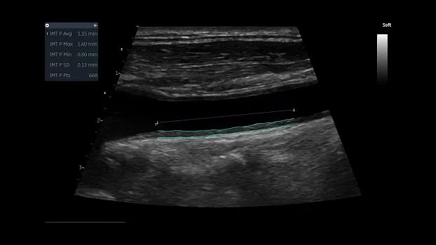 Клинические изображения Ультразвуковая диагностическая система GE HealthCare Vivid iQ портативная