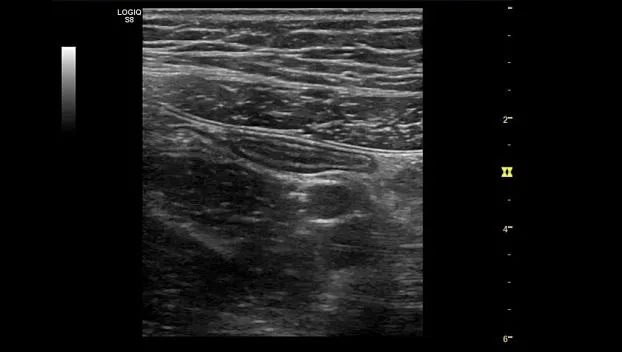 Клинические изображения GE Logiq S8 XDclear ультразвуковая диагностическая система 