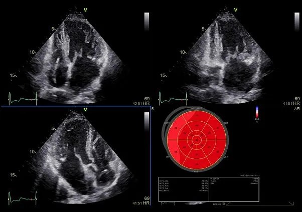 Клинические изображения Ультразвуковая диагностическая система GE HealthCare Vivid iQ портативная