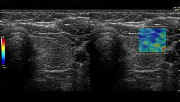 Клинические изображения GE Logiq S8 XDclear ультразвуковая диагностическая система 