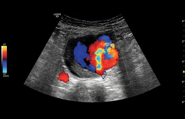 Клинические изображения УЗИ аппарат GE Healthcare Logiq E9 XDclear