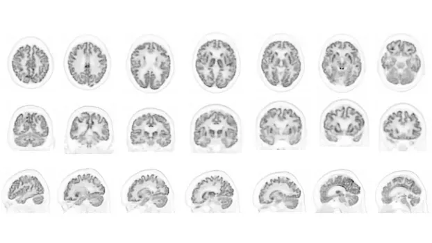 Клинические изображения Siemens Biograph Vision ПЭТ-КТ