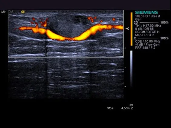 Клинические изображения Siemens Acuson S3000 ультразвуковая система