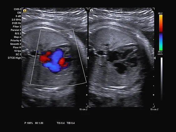 Клинические изображения Ультразвуковая система Siemens Acuson NX3 Elite