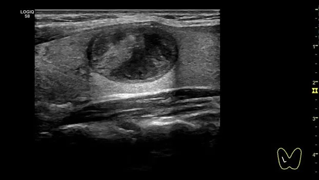 Клинические изображения GE Logiq S8 XDclear ультразвуковая диагностическая система 