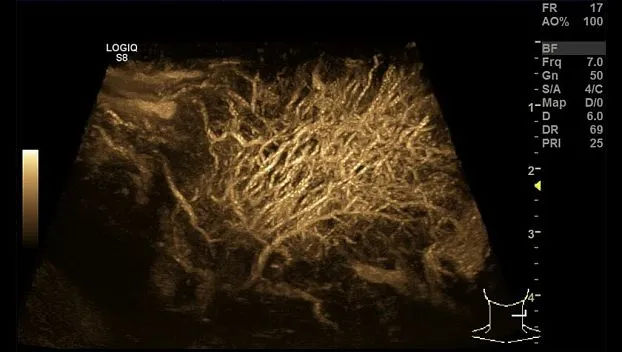 Клинические изображения GE Logiq S8 XDclear ультразвуковая диагностическая система 