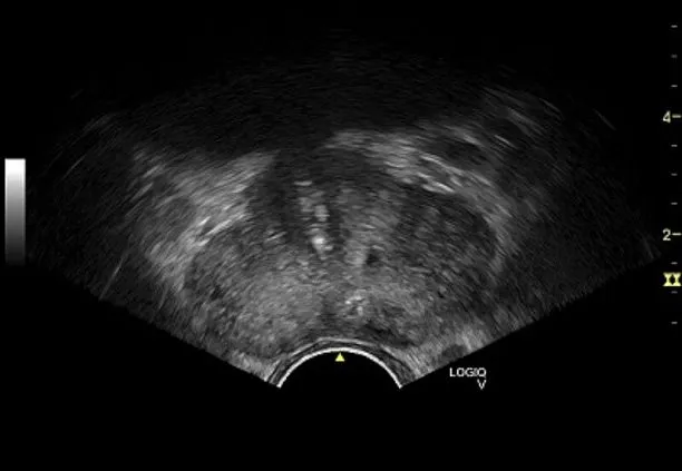 Клинические изображения Ультразвуковая диагностическая система GE Logiq V2 УЗИ портативная