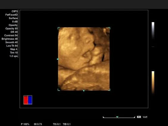 Клинические изображения Siemens Acuson NX2 Elite аппарат УЗИ