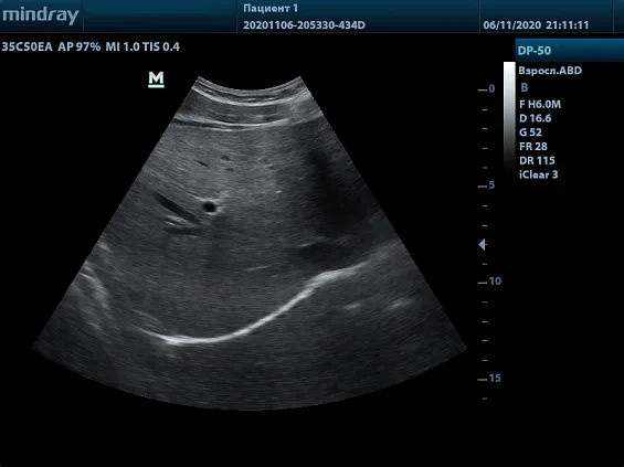 Клинические изображения УЗИ аппарат Mindray DP-50 Color портативный