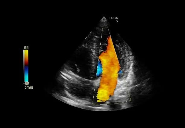 Клинические изображения Ультразвуковая диагностическая система GE Logiq V2 УЗИ портативная