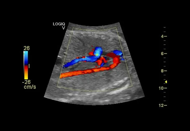 Клинические изображения Ультразвуковая диагностическая система GE Logiq V2 УЗИ портативная