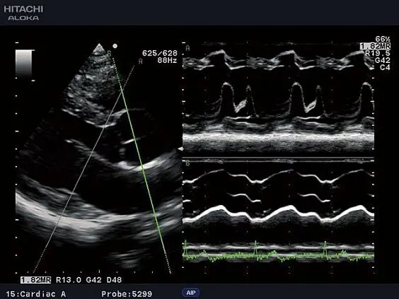 Клинические изображения УЗИ аппарат Fujifilm (Hitachi) Aloka ProSound F31