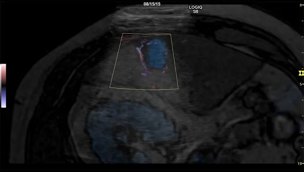 Клинические изображения GE Logiq S8 XDclear ультразвуковая диагностическая система 