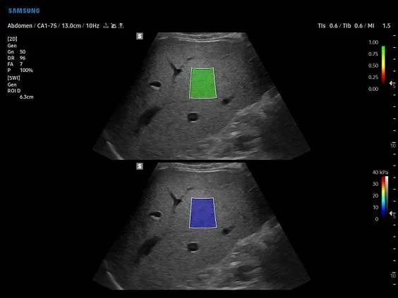 Клинические изображения Samsung Medison V8 УЗИ аппарат