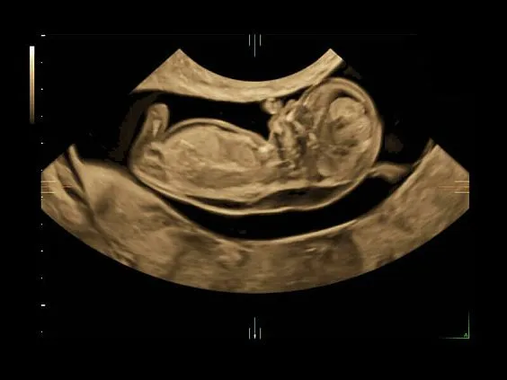 Клинические изображения Ультразвуковая диагностическая система GE Voluson E10