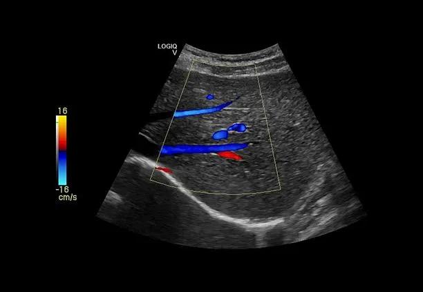 Клинические изображения Ультразвуковая диагностическая система GE Logiq V2 УЗИ портативная