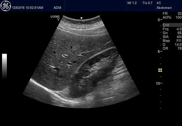 Клинические изображения Ультразвуковая диагностическая система GE Logiq V2 УЗИ портативная